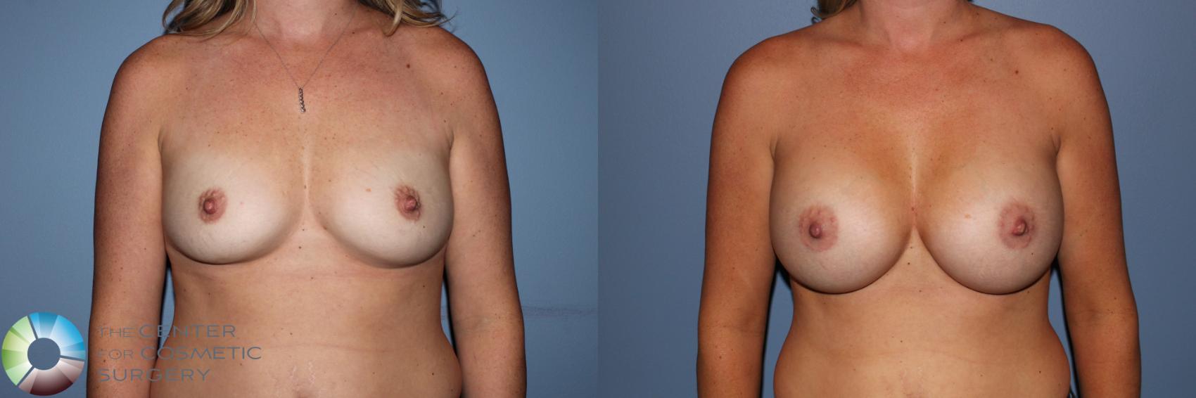 Before & After Breast Augmentation Case 11595 Front in Denver and Colorado Springs, CO