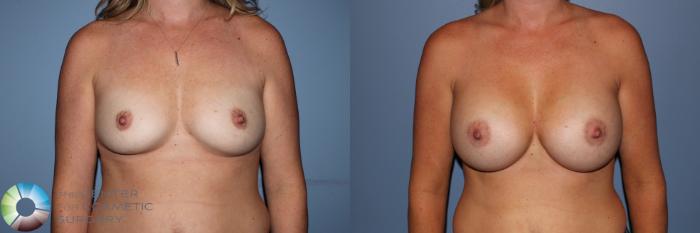 Before & After Breast Augmentation Case 11595 Front in Denver and Colorado Springs, CO