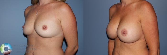 Before & After Breast Augmentation Case 11595 Left Oblique in Denver and Colorado Springs, CO