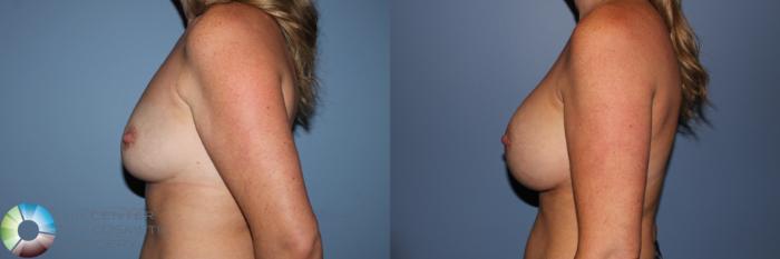 Before & After Breast Augmentation Case 11595 Left Side in Denver and Colorado Springs, CO