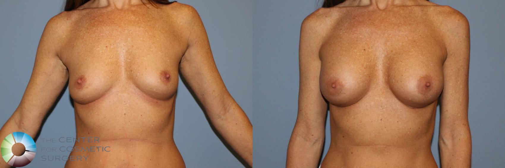 Before & After Breast Augmentation Case 11601 Front in Denver and Colorado Springs, CO