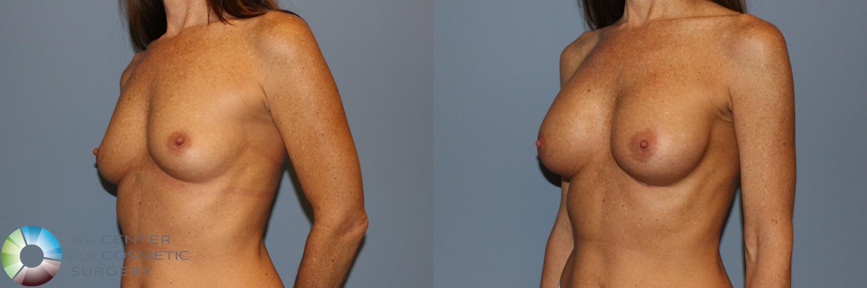 Before & After Breast Augmentation Case 11601 Left Oblique in Denver and Colorado Springs, CO
