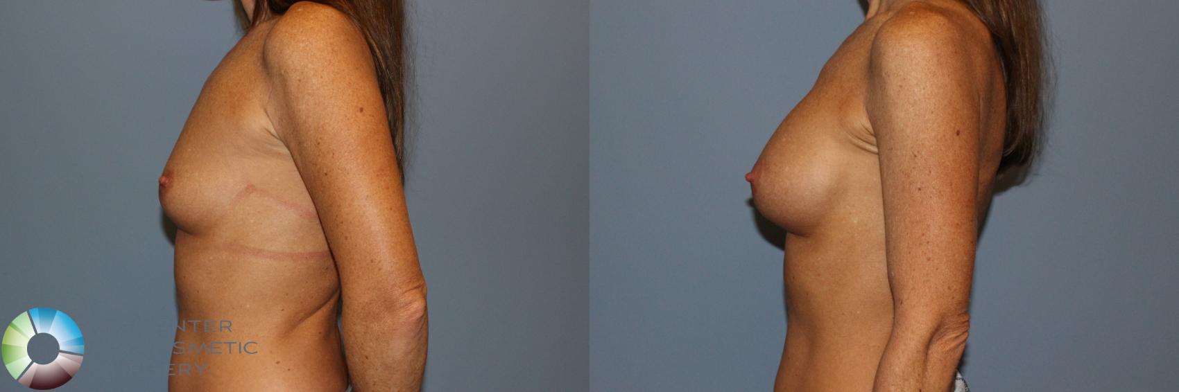 Before & After Breast Augmentation Case 11601 Left Side in Denver and Colorado Springs, CO