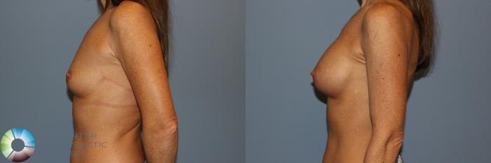 Before & After Breast Augmentation Case 11601 Left Side View in Golden, CO