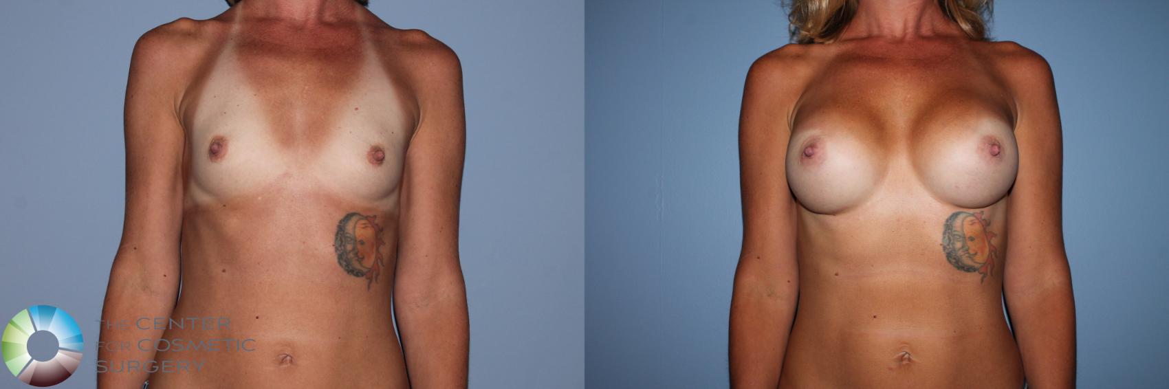 Before & After Breast Augmentation Case 11602 Front View in Golden, CO