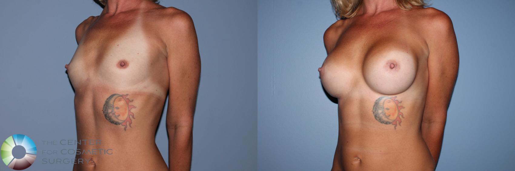 Before & After Breast Augmentation Case 11602 Left Oblique View in Golden, CO
