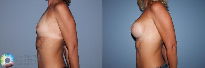 Before & After Breast Augmentation Case 11602 Left Side View in Golden, CO