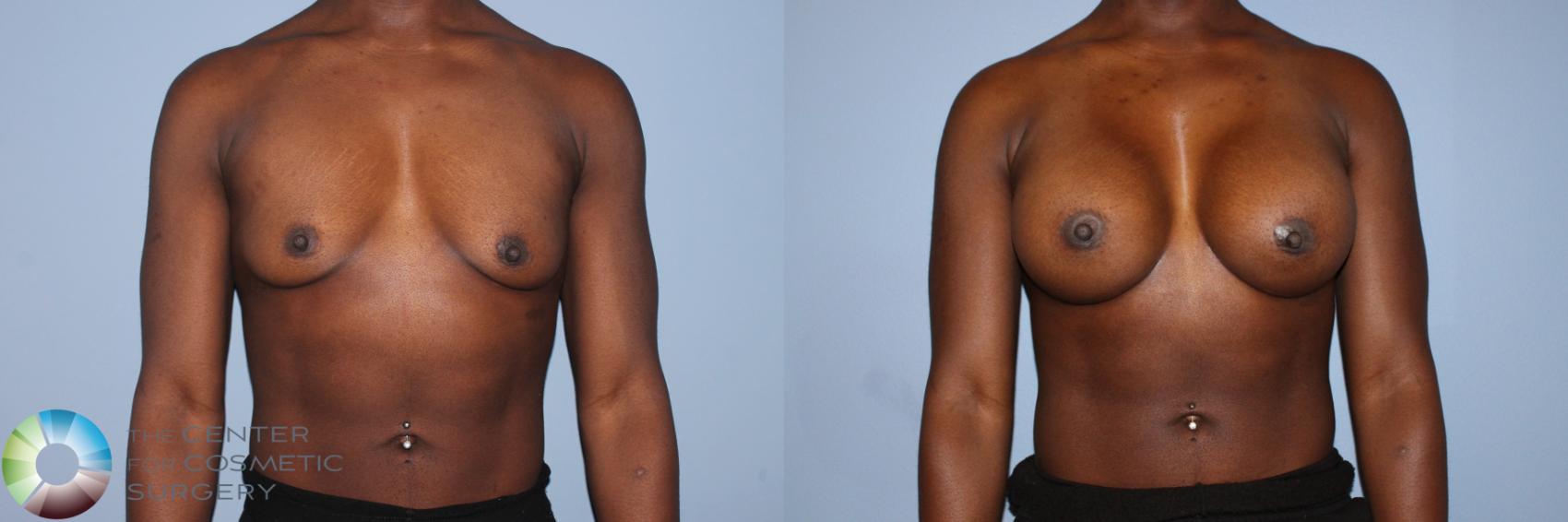 Before & After Breast Augmentation Case 11603 Front in Denver and Colorado Springs, CO