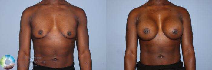 Before & After Breast Augmentation Case 11603 Front View in Golden, CO
