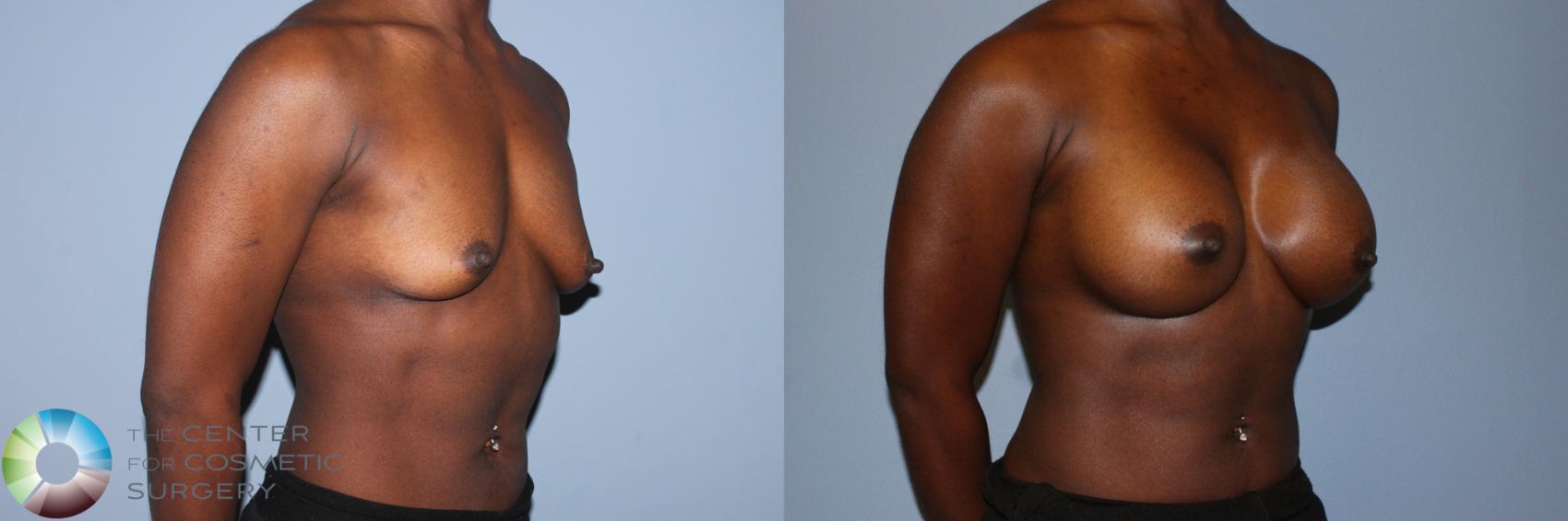 Before & After Breast Augmentation Case 11603 Right Oblique in Denver and Colorado Springs, CO