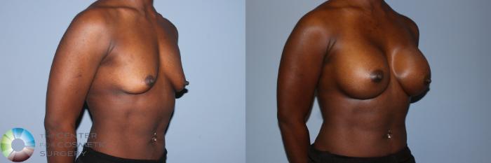 Before & After Breast Augmentation Case 11603 Right Oblique View in Golden, CO