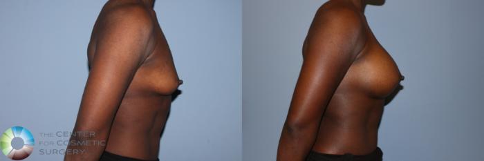 Before & After Breast Augmentation Case 11603 Right Side View in Golden, CO