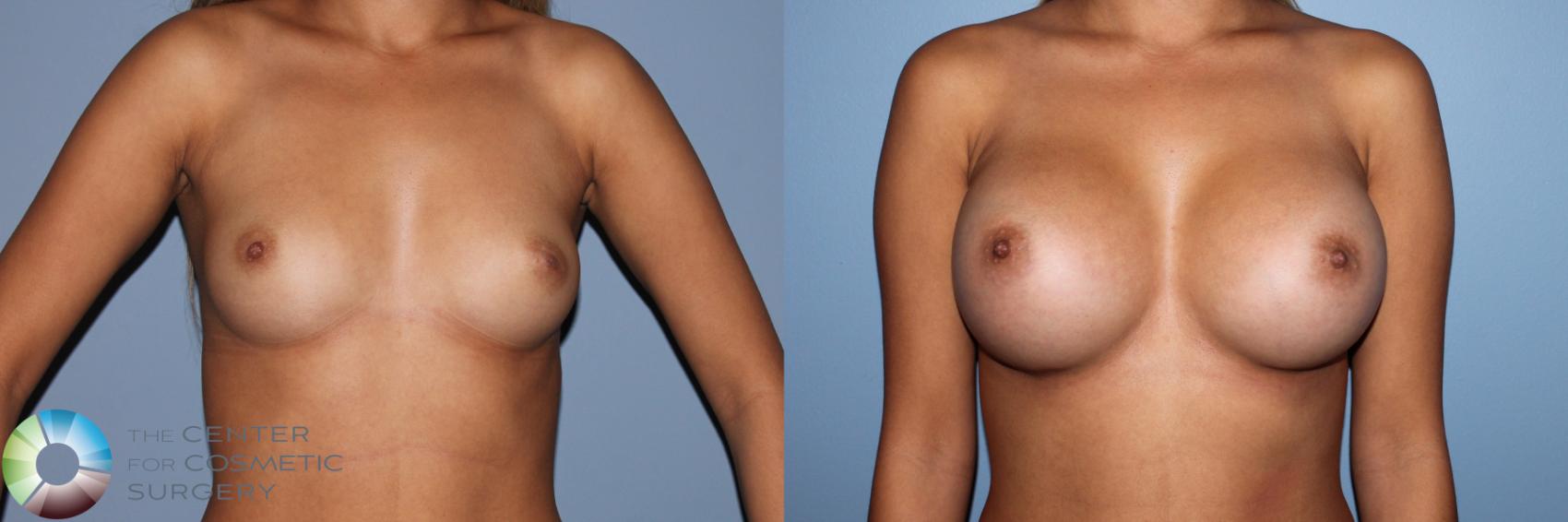 Before & After Breast Augmentation Case 11607 Front View in Golden, CO