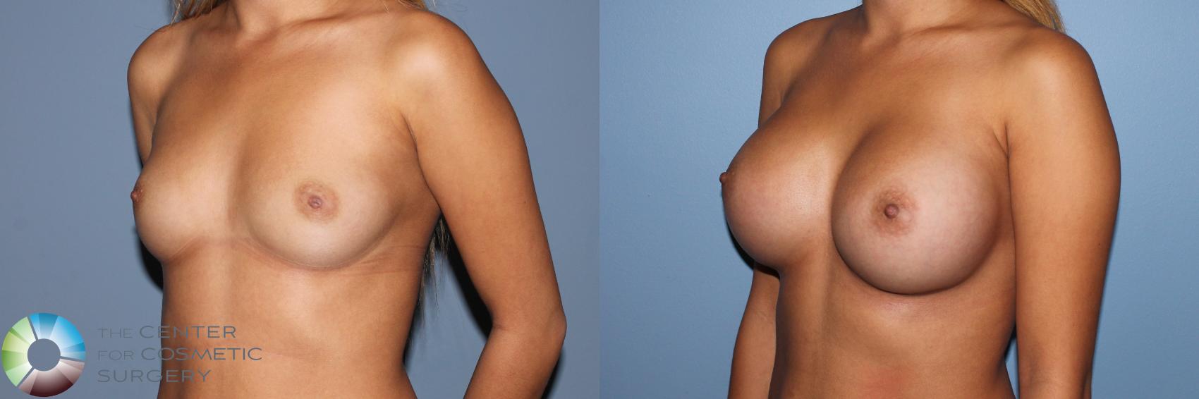 Before & After Breast Augmentation Case 11607 Left Oblique View in Golden, CO