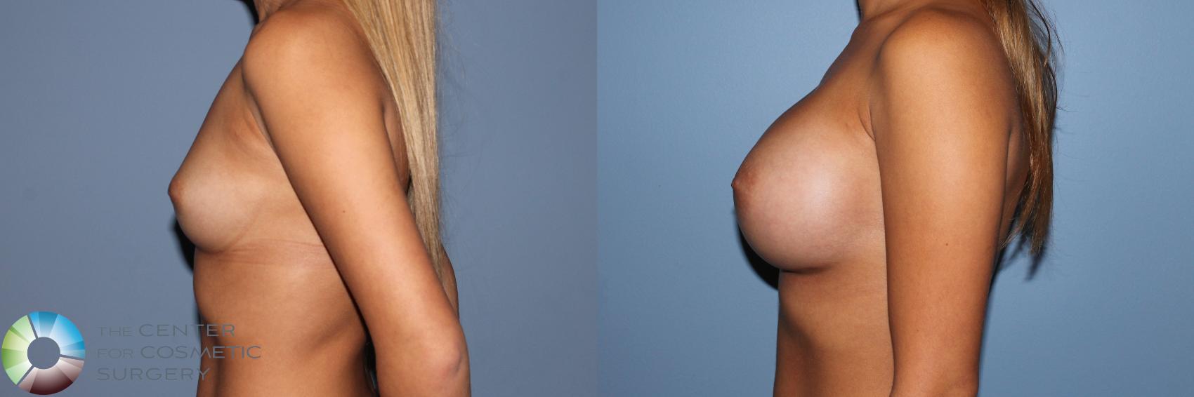 Before & After Breast Augmentation Case 11607 Left Side View in Golden, CO
