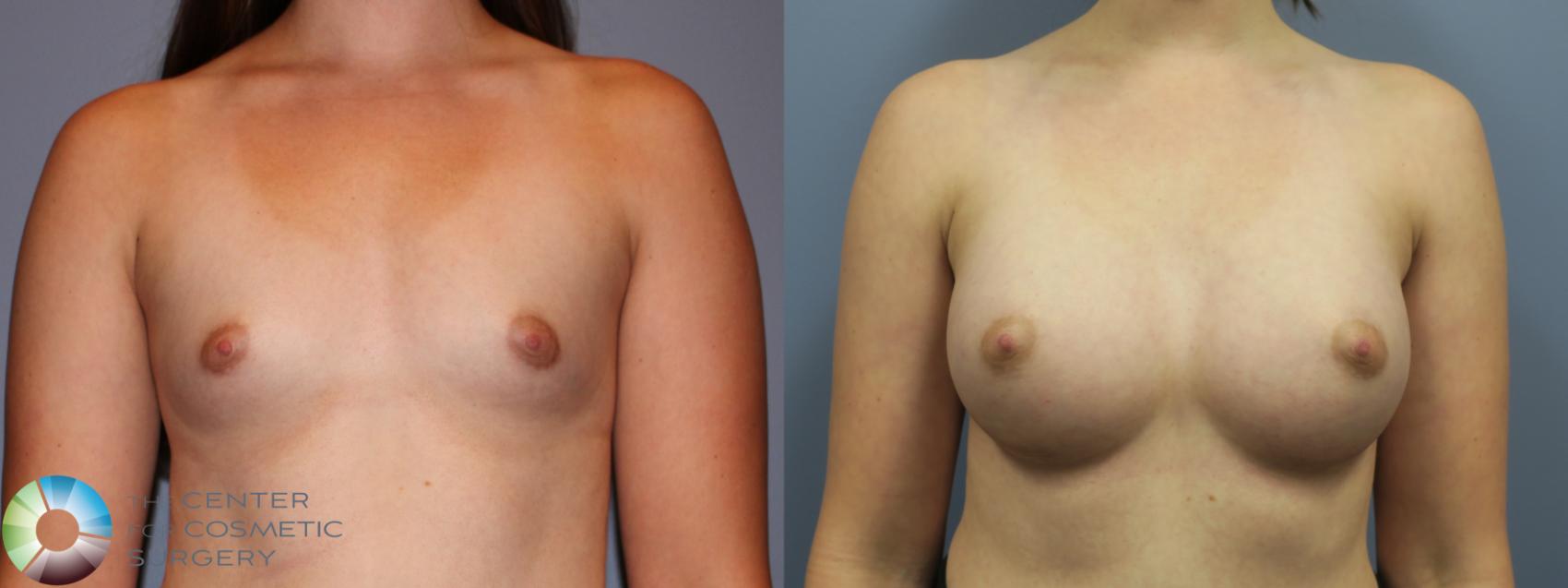 Before & After Breast Augmentation Case 11612 Front in Denver and Colorado Springs, CO