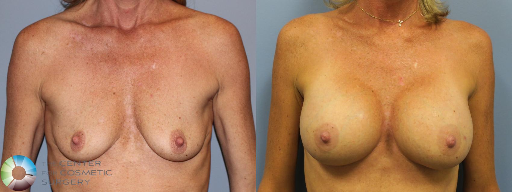 Before & After Breast Augmentation Case 11613 Front in Denver and Colorado Springs, CO