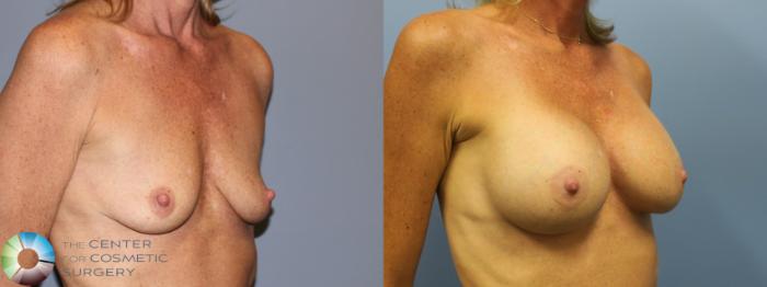 Before & After Breast Augmentation Case 11613 Right Oblique in Denver and Colorado Springs, CO