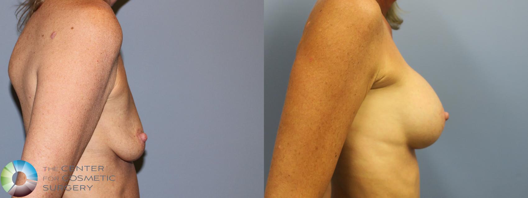 Before & After Breast Augmentation Case 11613 Right Side in Denver and Colorado Springs, CO