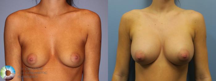 Before & After Breast Augmentation Case 11615 Front in Denver and Colorado Springs, CO
