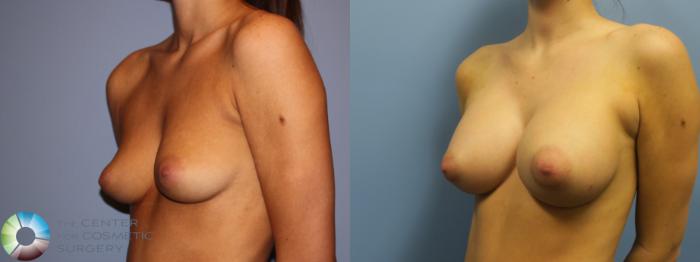 Before & After Breast Augmentation Case 11615 Left Oblique in Denver and Colorado Springs, CO