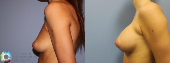 Before & After Breast Augmentation Case 11615 Left Side in Denver and Colorado Springs, CO