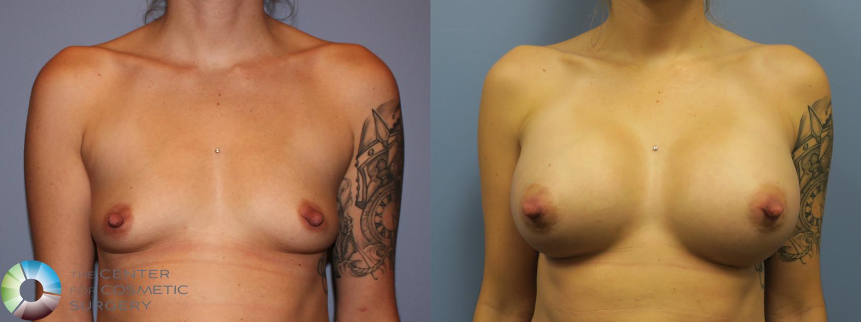 Before & After Breast Augmentation Case 11617 Front View in Golden, CO