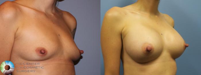 Before & After Breast Augmentation Case 11617 Right Oblique View in Golden, CO