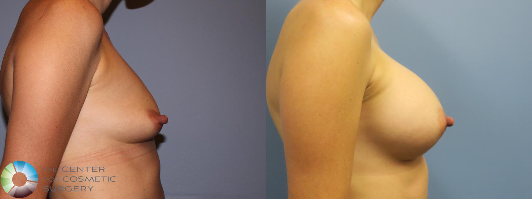 Before & After Breast Augmentation Case 11617 Right Side in Denver and Colorado Springs, CO