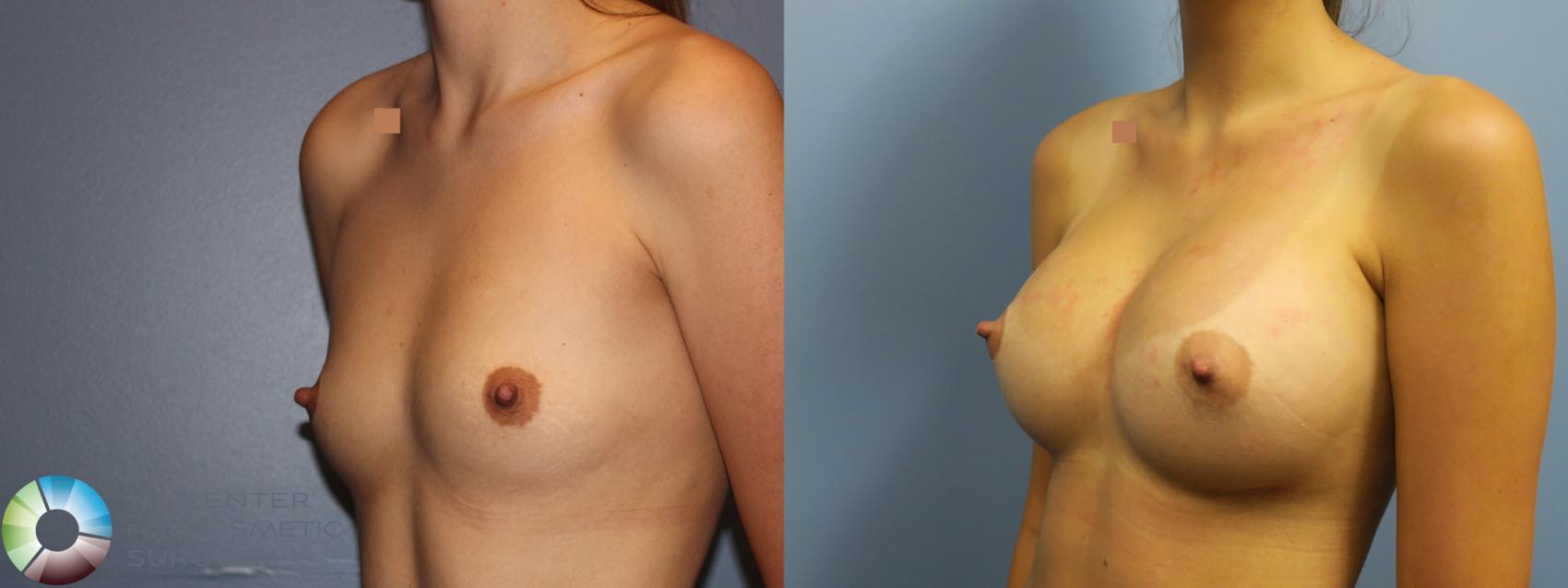 Before & After Breast Augmentation Case 11618 Left Oblique in Denver and Colorado Springs, CO