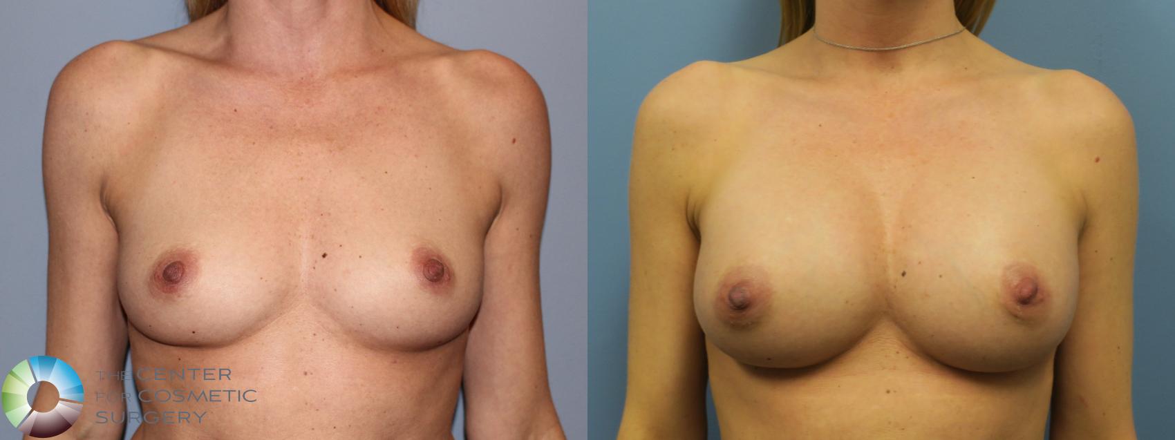 Before & After Breast Augmentation Case 11619 Front in Denver and Colorado Springs, CO