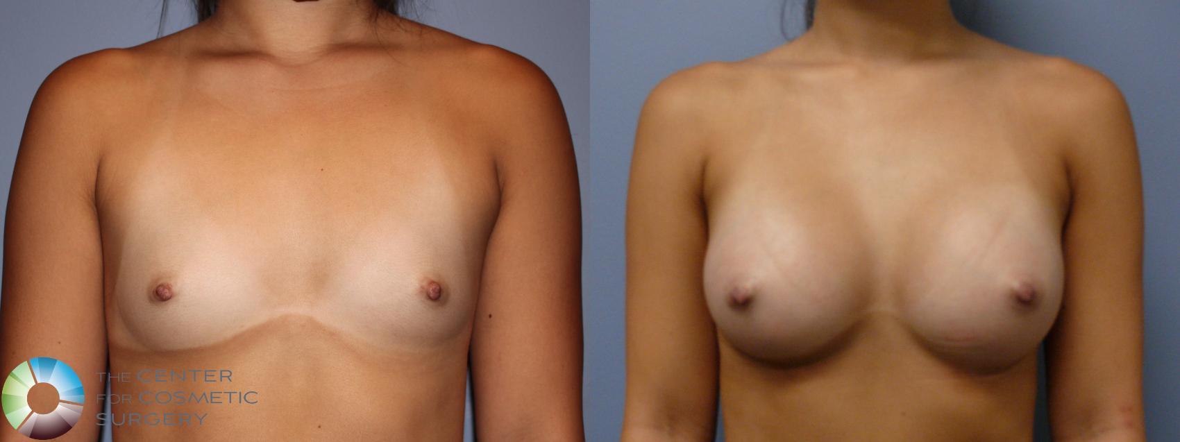 Before & After Breast Augmentation Case 11620 Front View in Golden, CO