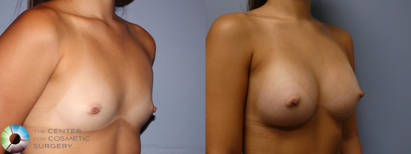 Before & After Breast Augmentation Case 11620 Right Oblique in Denver and Colorado Springs, CO