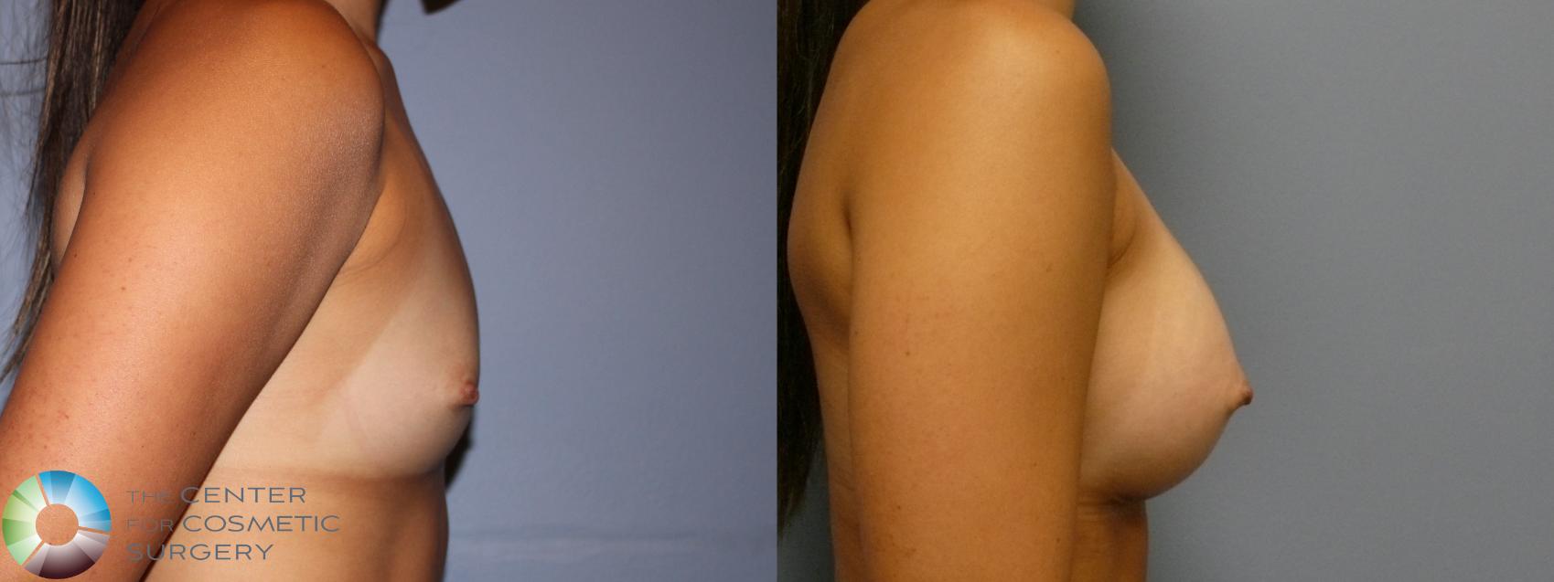Before & After Breast Augmentation Case 11620 Right Side in Denver and Colorado Springs, CO