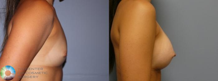 Before & After Breast Augmentation Case 11620 Right Side View in Golden, CO