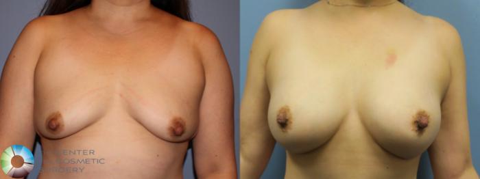 Before & After Breast Augmentation Case 11621 Front in Denver, CO
