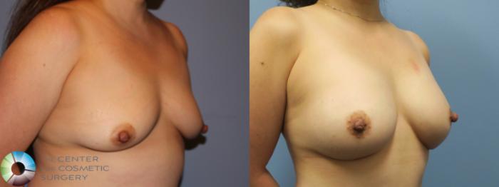 Before & After Breast Augmentation Case 11621 Right Oblique in Denver, CO