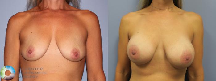 Before & After Breast Augmentation Case 11647 Front in Denver and Colorado Springs, CO