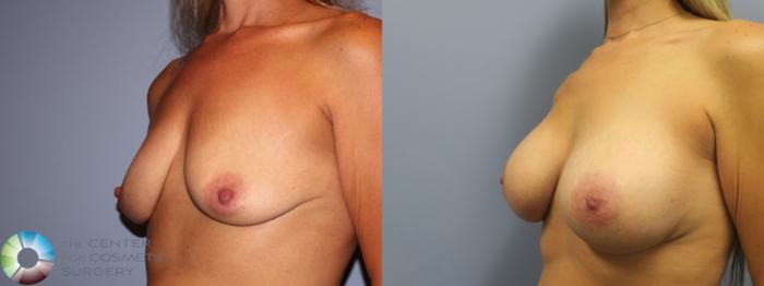 Before & After Breast Augmentation Case 11647 Left Oblique in Denver and Colorado Springs, CO