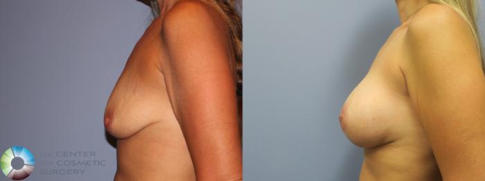 Before & After Breast Augmentation Case 11647 Left Side in Denver and Colorado Springs, CO