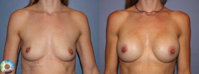 Before & After Breast Augmentation Case 11650 Front in Denver and Colorado Springs, CO