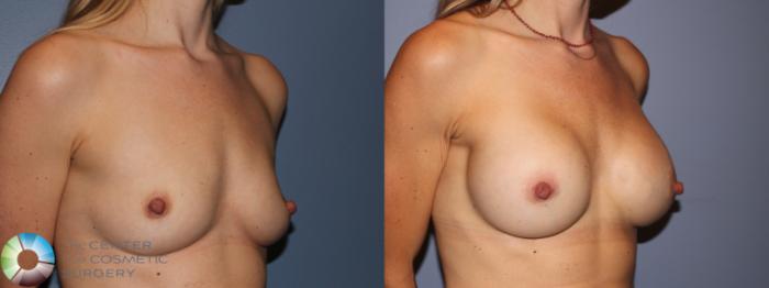 Before & After Breast Augmentation Case 11650 Right Oblique in Denver and Colorado Springs, CO