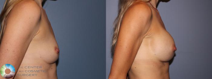 Before & After Breast Augmentation Case 11650 Right Side in Denver and Colorado Springs, CO