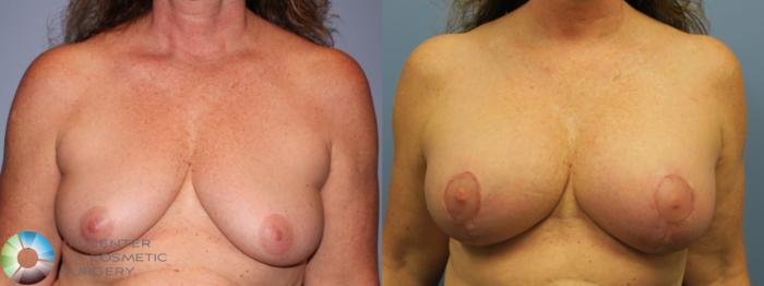 Before & After Breast Augmentation Case 11652 Front View in Golden, CO