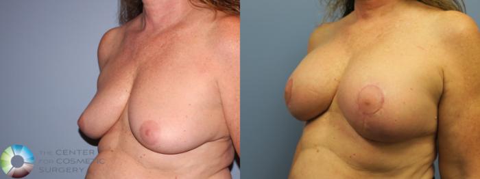 Before & After Breast Augmentation Case 11652 Left Oblique View in Golden, CO