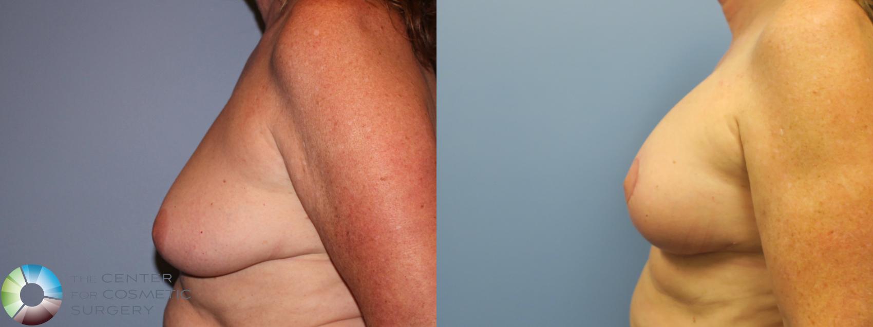 Before & After Breast Augmentation Case 11652 Left Side View in Golden, CO