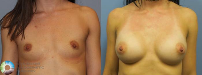 Before & After Breast Augmentation Case 11654 Front in Denver and Colorado Springs, CO