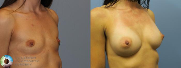 Before & After Breast Augmentation Case 11654 Right Oblique in Denver and Colorado Springs, CO
