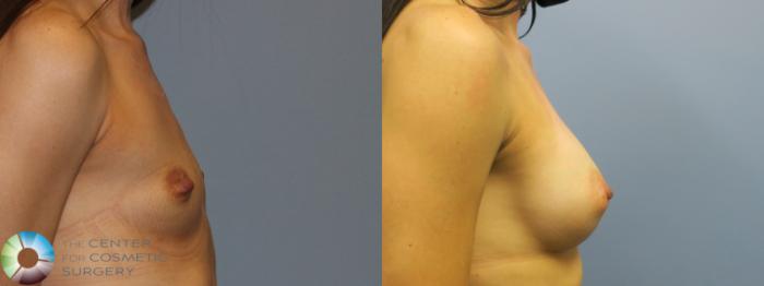 Before & After Breast Augmentation Case 11654 Right Side in Denver and Colorado Springs, CO