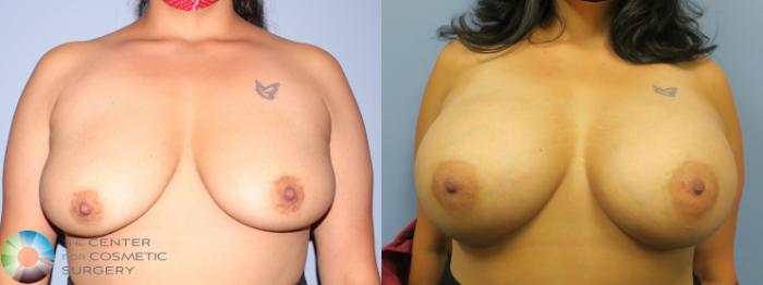 Before & After Breast Augmentation Case 11655 Front in Denver and Colorado Springs, CO
